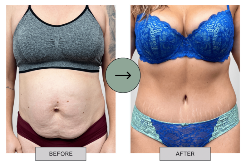tummy tuck before & after